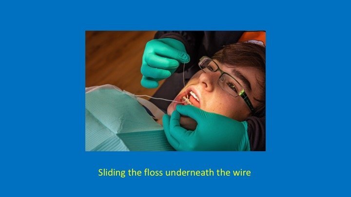 staff member sliding floss underneath a patient's braces wire