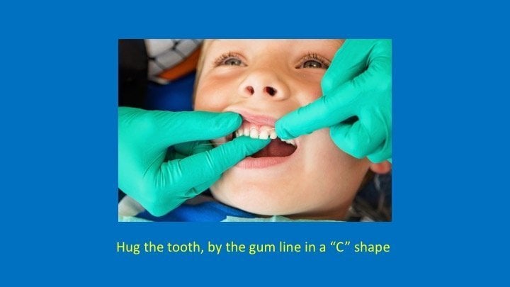 staff member hugging the tooth, by the gum line, in a 'C' shape