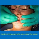 staff member using an interproximal brush under the hooks