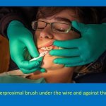 staff member using an interproximal brush under the wire and against the brackets