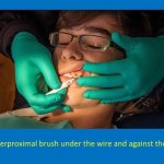 staff member using an interproximal brush under the wire and against the brackets