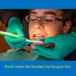 staff member brushing under the brackets by the gum line