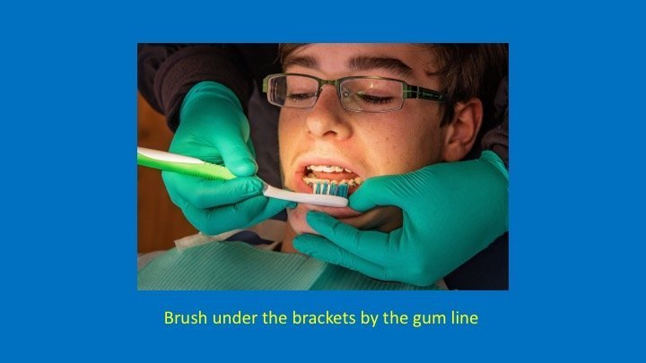 staff member brushing under the brackets by the gum line